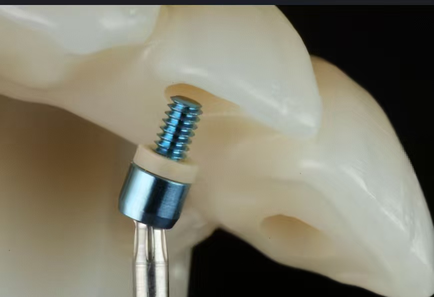 CNC-machined dental implant screws for restoration