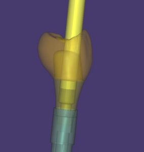 Exocad design for dental labs